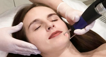 Удаление шрамов лазером MCL31 DERMABLATE